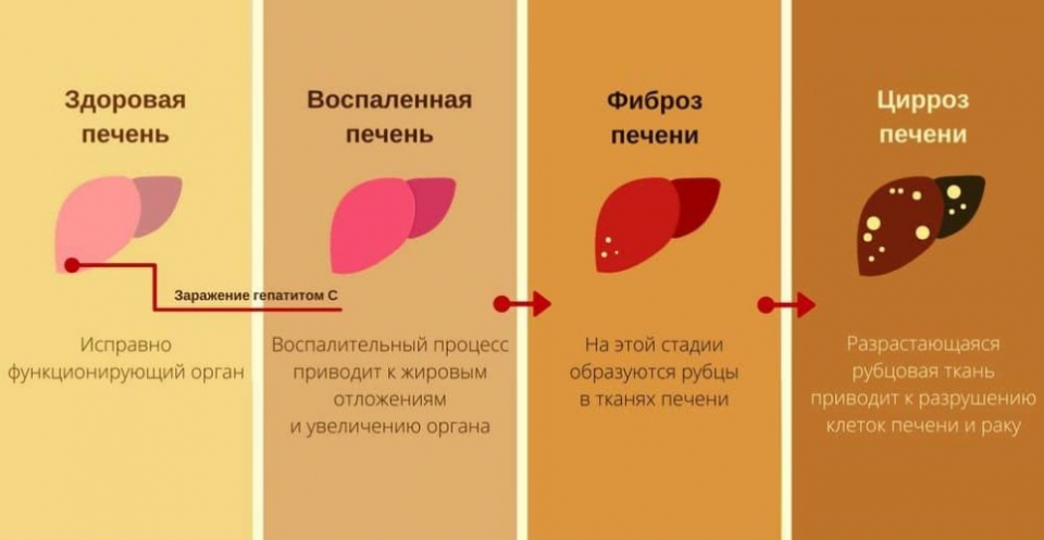 Гепатит с что делать