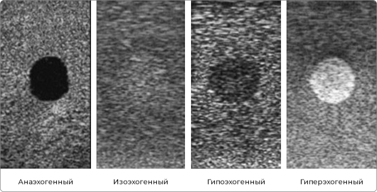 Гипоэхогенный узел щитовидной железы что это такое