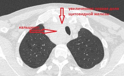 Кальцинаты в щитовидной железе