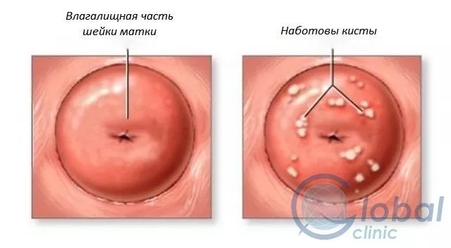 Киста на шейке