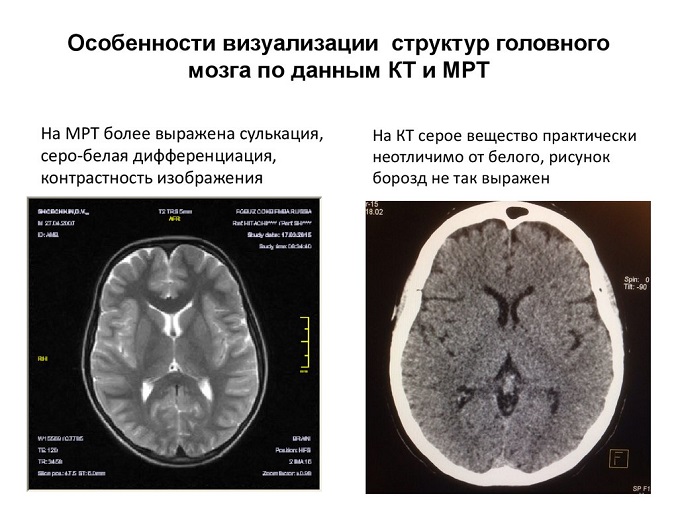 Кт головного мозга что показывает чем отличается от мрт