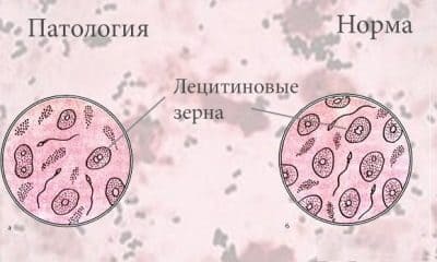 Лецитиновые зерна в соке простаты