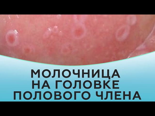 Молочница у парней