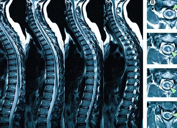 Мрт головного и спинного мозга