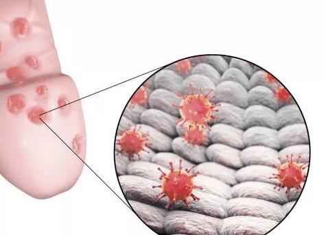 Молочница у мужчин как появляется