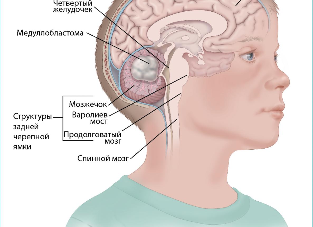 Киста на мозжечке