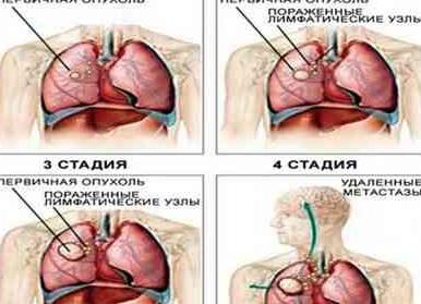 Карцинома легких что это такое и сколько проживет человек