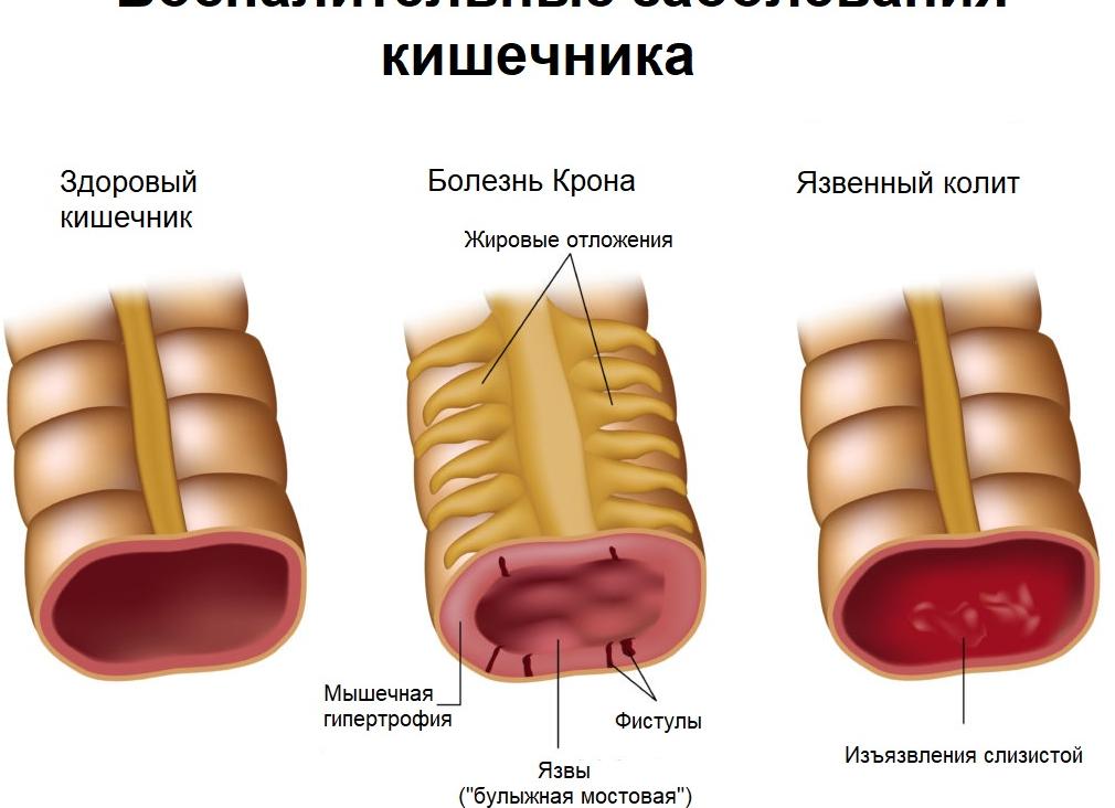Кальпротектин фекальный что