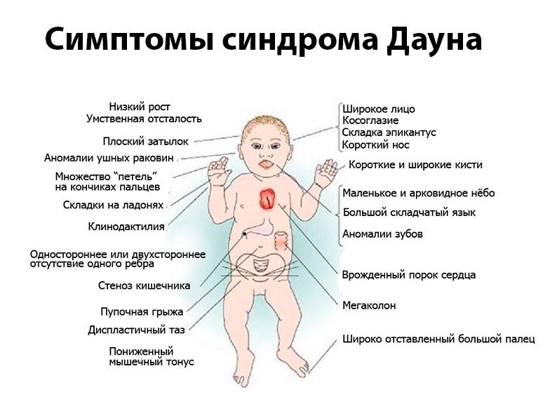 Как проявляется синдром дауна Как проявляется синдром дауна
