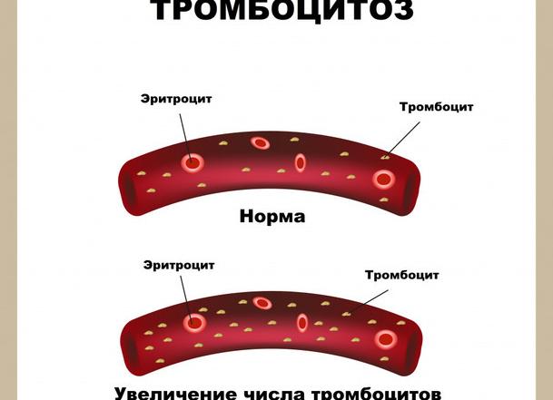 Как понизить тромбоциты в крови быстро и эффективно