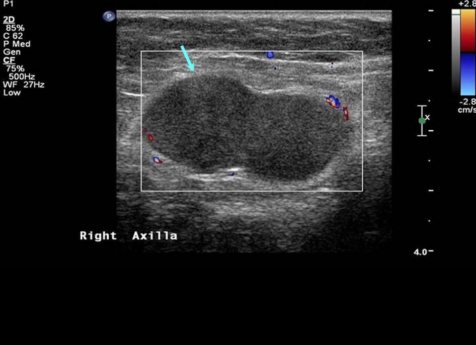 Гипоэхогенные лимфоузлы это что