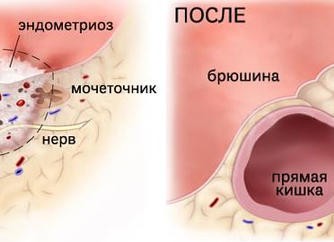 Эндометриоз видно ли на узи