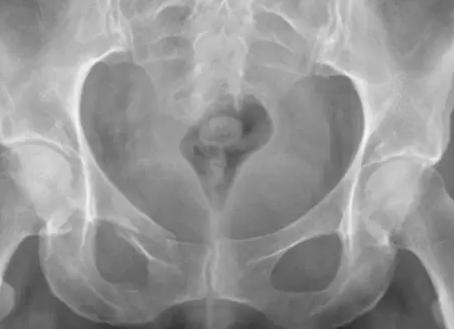 Что можно есть перед рентгеном поясничного отдела позвоночника