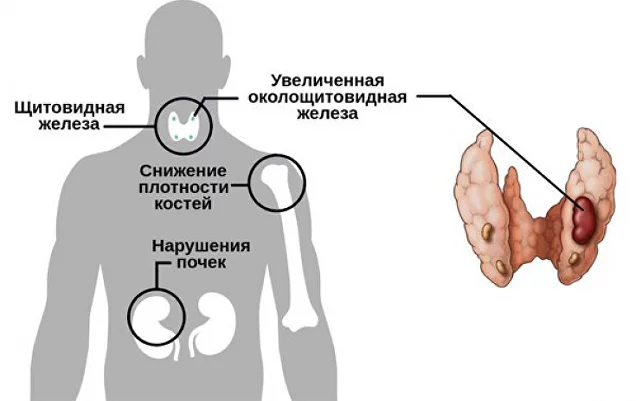 Как снизить паратгормон
