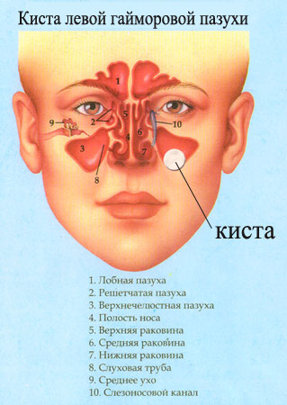 Киста верхнечелюстной пазухи размеры для удаления