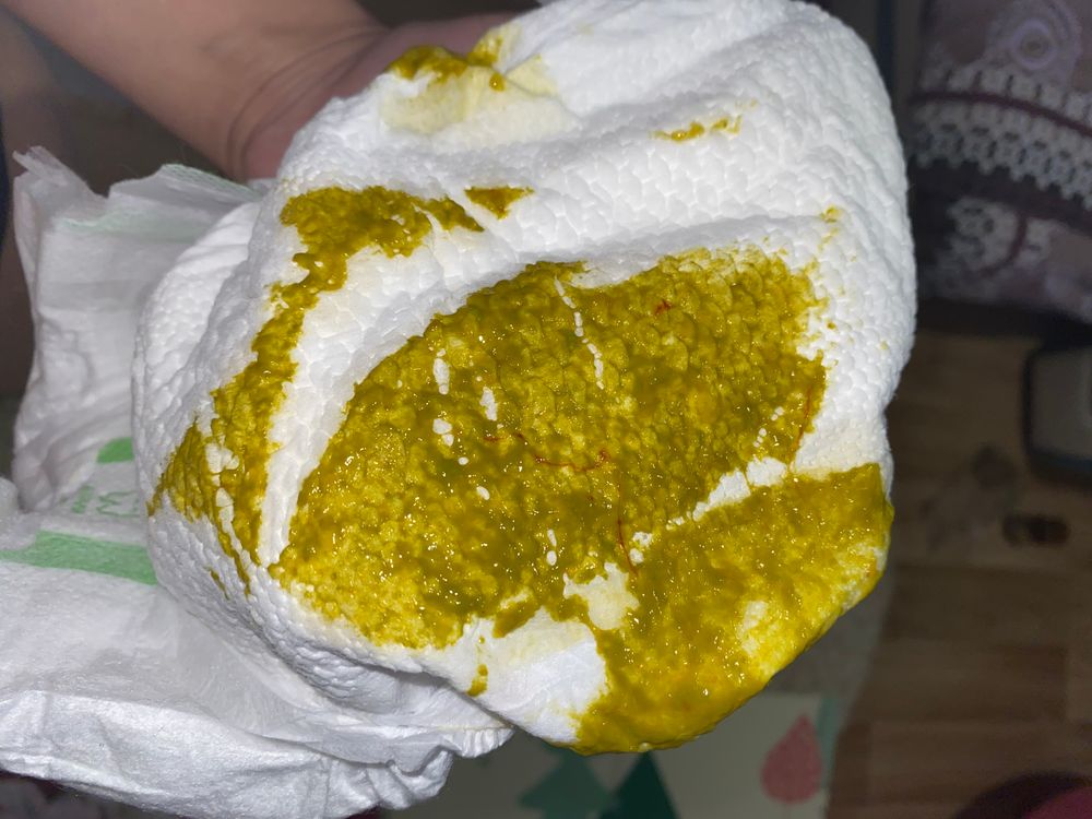 Кровавые прожилки в кале у грудничка
