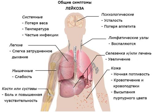 Лейкоз признаки заболевания у взрослых