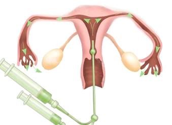 На какой день делают гсг