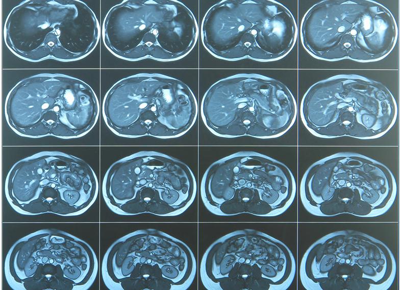 Мрт забрюшинного пространства какие органы проверяют