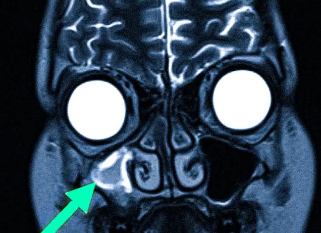 Мрт при гайморите