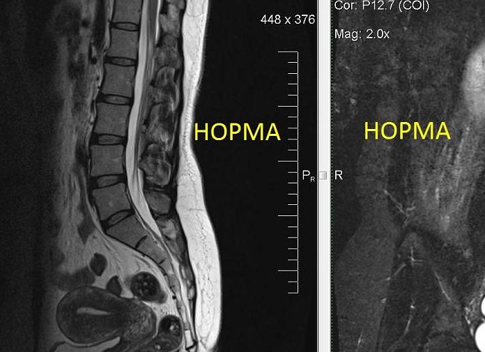 Мрт поп что это