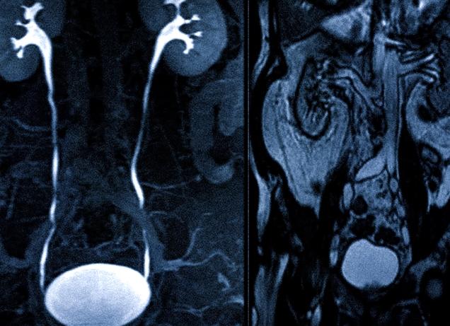 Мрт мочевого пузыря что показывает Мрт мочевого пузыря что показывает