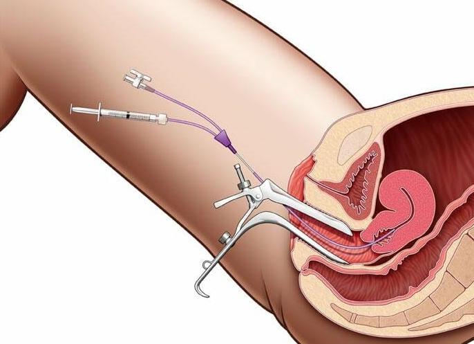 Маточные трубы как проверяют