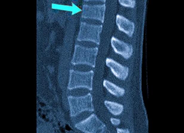 Кт пояснично крестцового отдела позвоночника