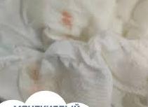 Кристаллы мочевой кислоты у ребенка в моче Кристаллы мочевой кислоты у ребенка в моче