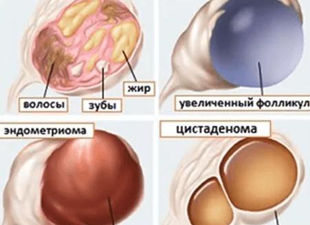 Какие виды бывают киста яичника