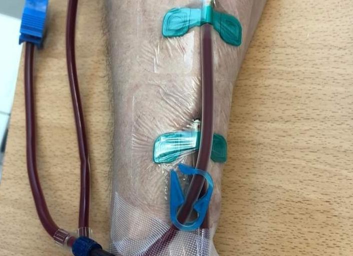 Гемодиализ что это такое и в каких случаях его проводят