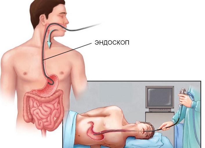 Что такое гастроскопия и как ее делают