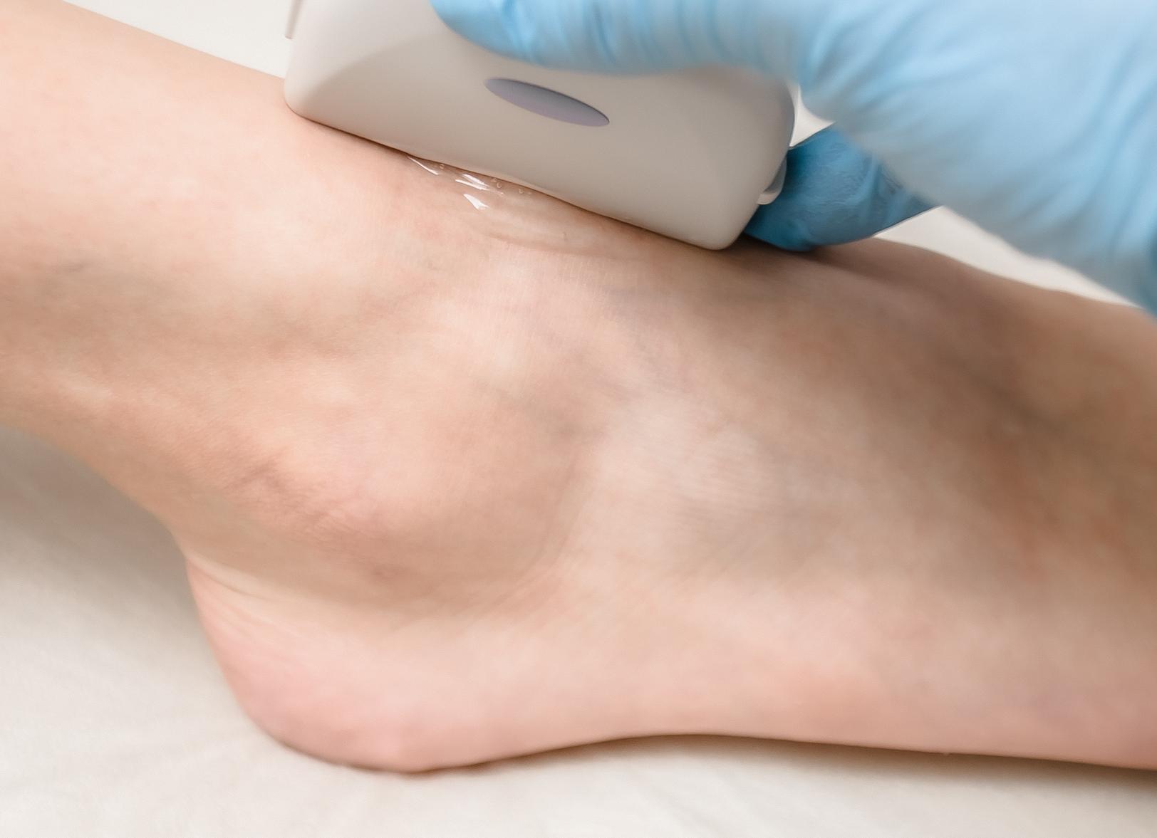 Что показывает узи стопы