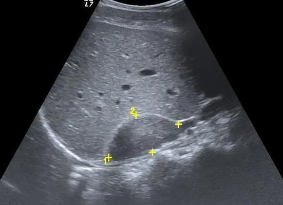 Что показывает узи надпочечников