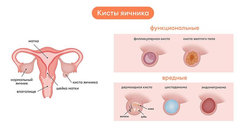 Какие бывают кисты яичников у женщин