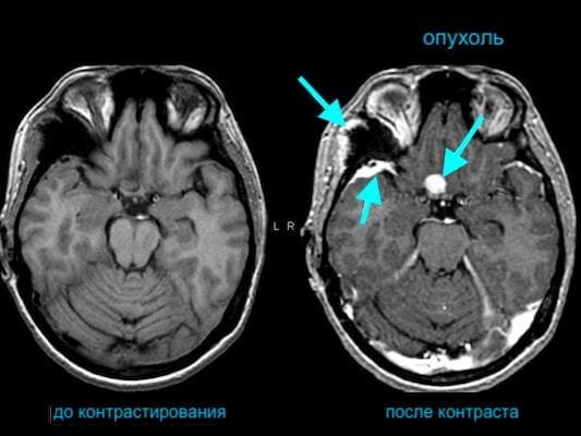 Мрт с контрастом или без в чем разница