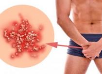 Молочница может быть у мужчин