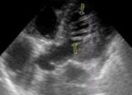 Малая аномалия развития сердца дополнительная хорда левого желудочка