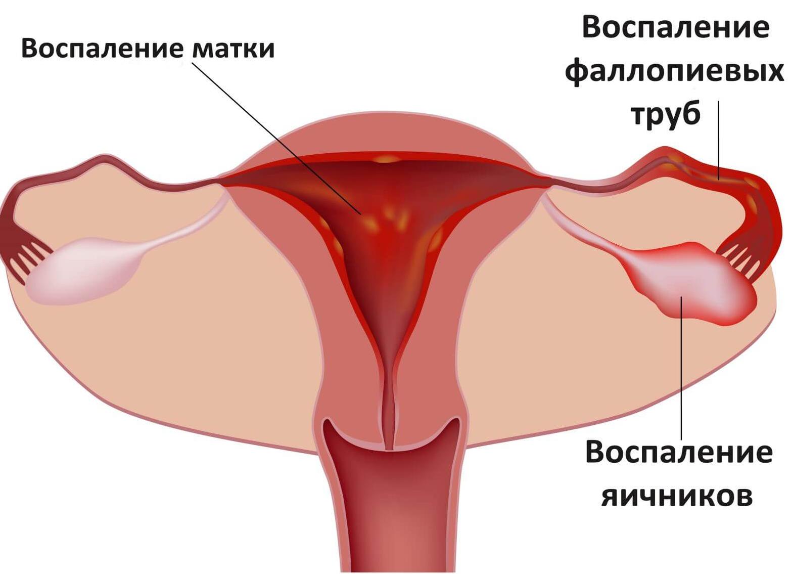 Левосторонний аднексит что это Левосторонний аднексит что это