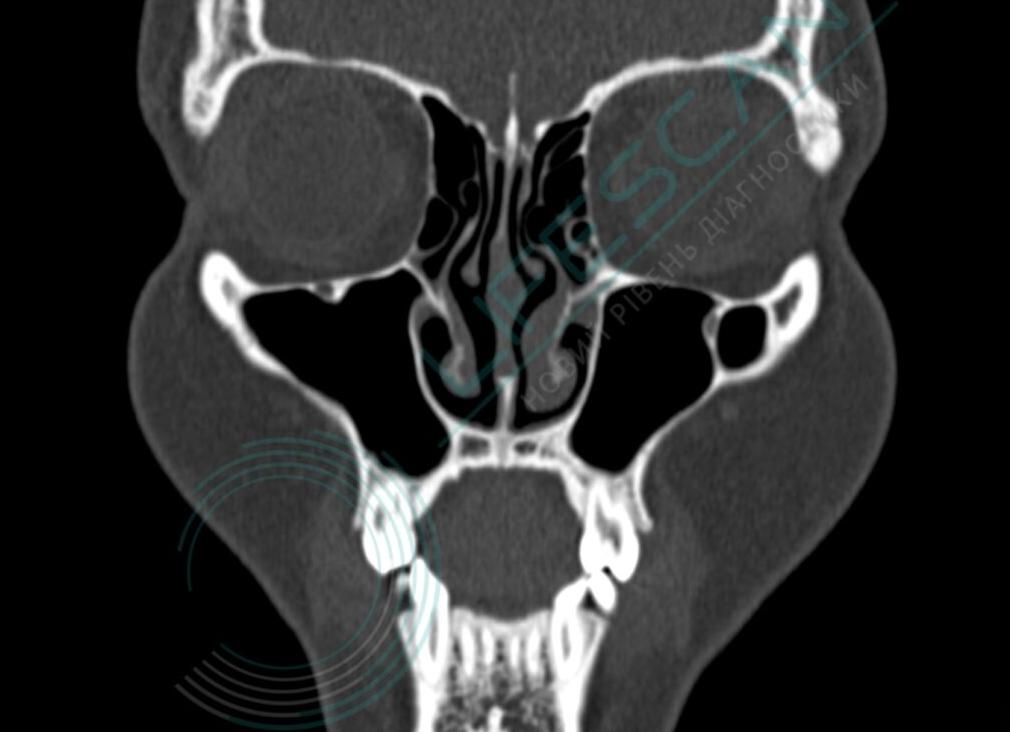 Компьютерная томография носа и околоносовых пазух