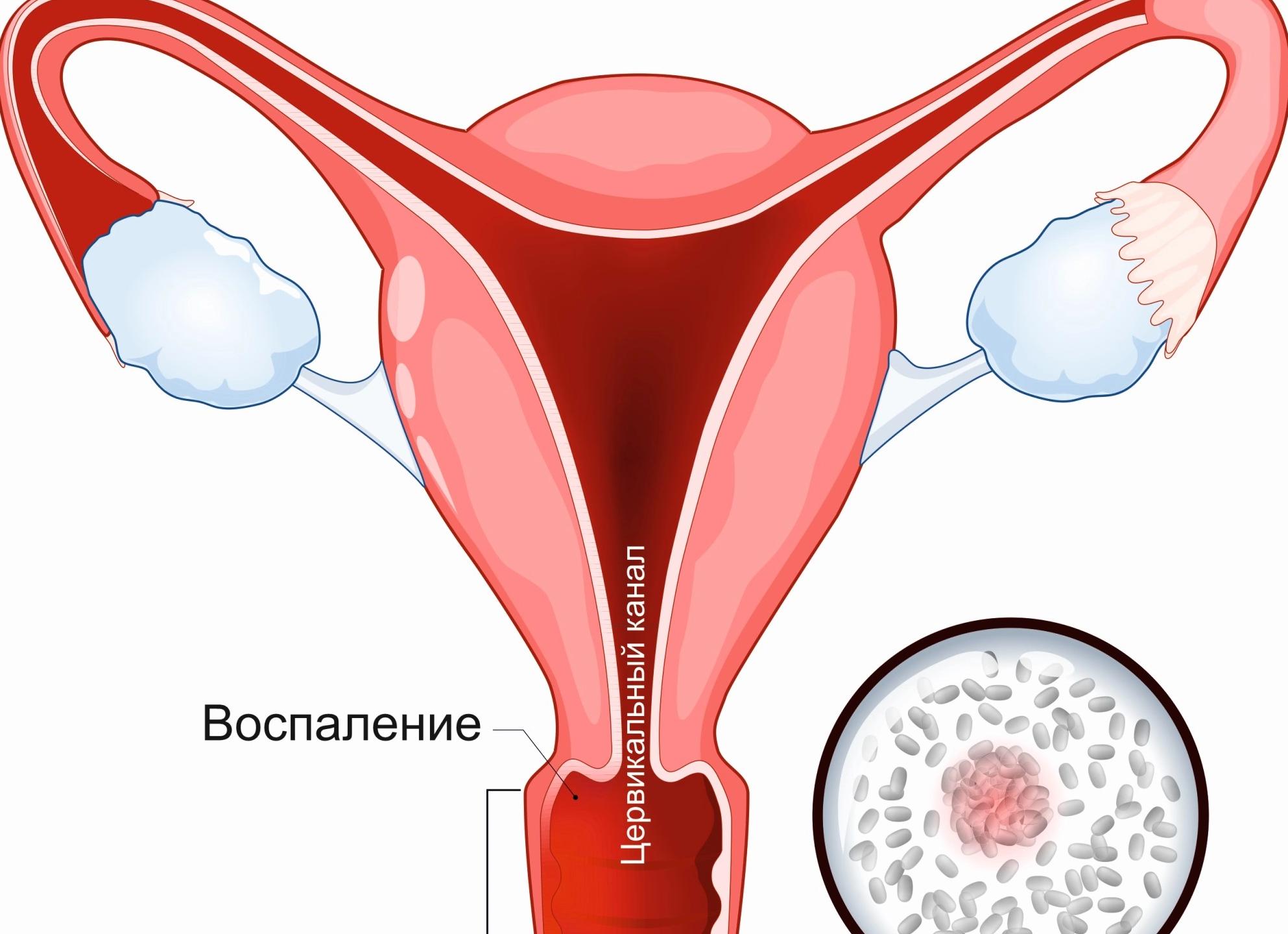 Гарднереллы у женщин что это