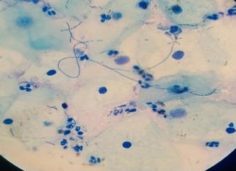 Фото лептотрикс в мазке