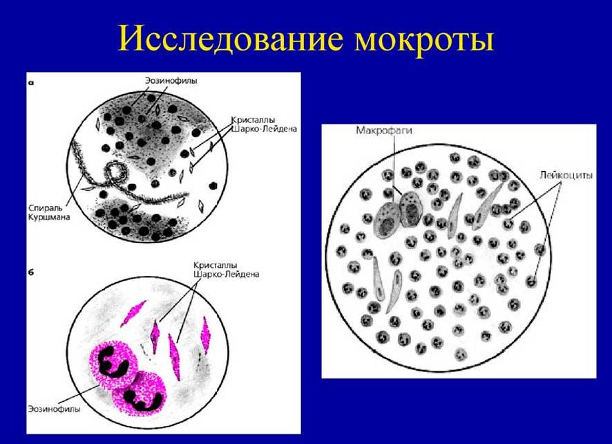 Эозинофилы в мокроте