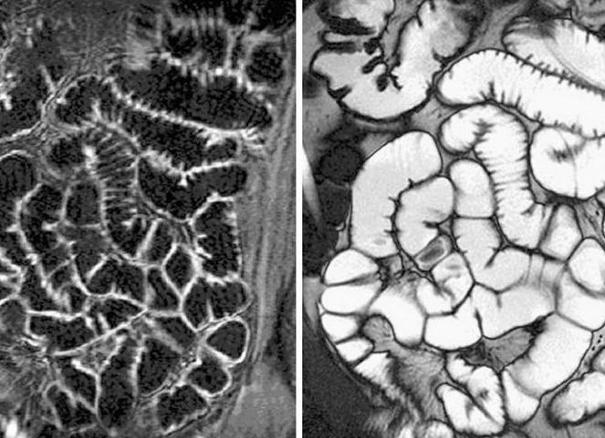 Энтерография тонкого кишечника