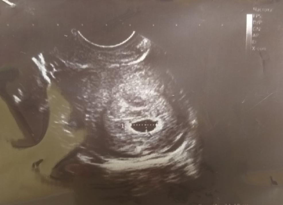 Эмбрион не лоцируется