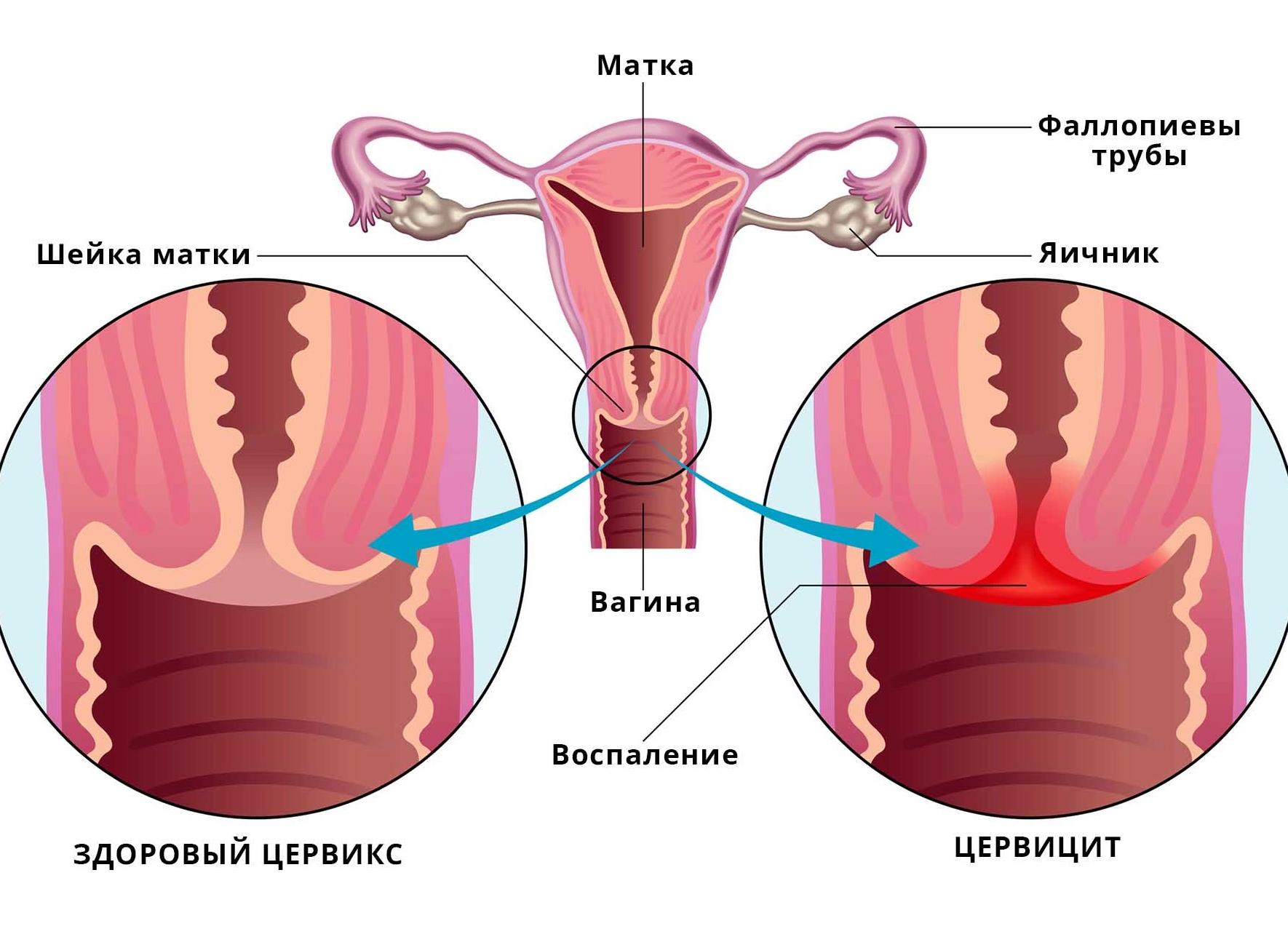 Экзоцервикс что это
