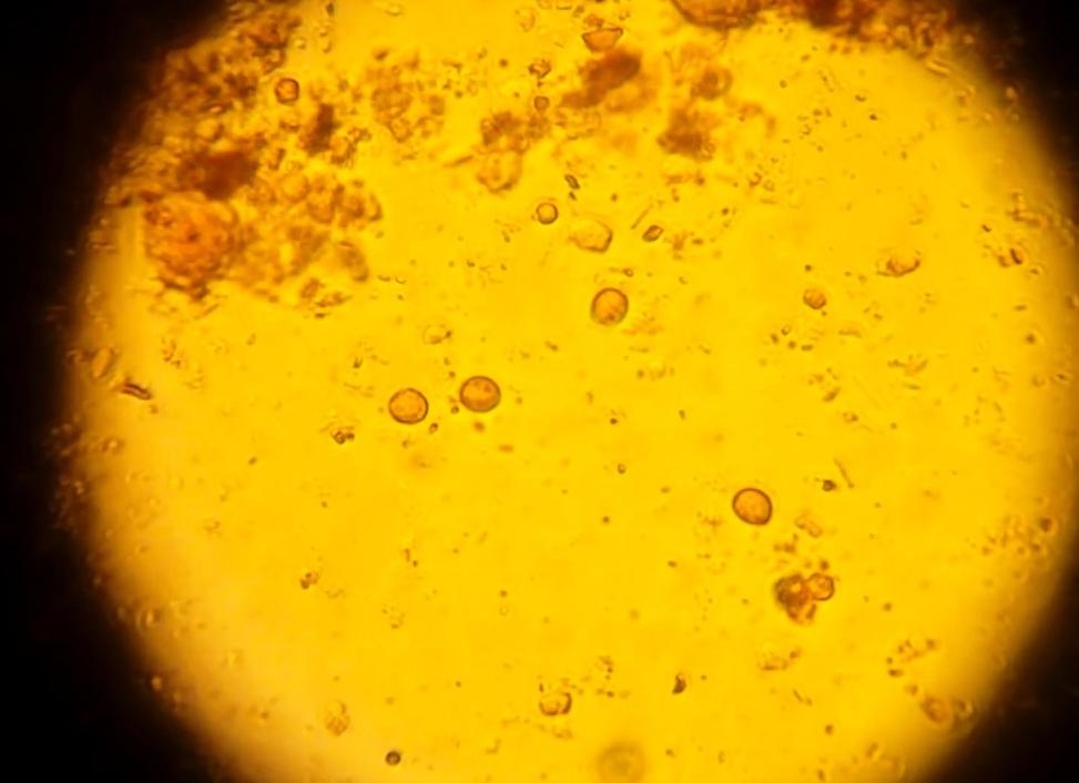 Цисты лямблий в кале