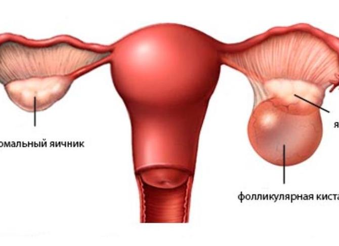 Что такое кистозное образование