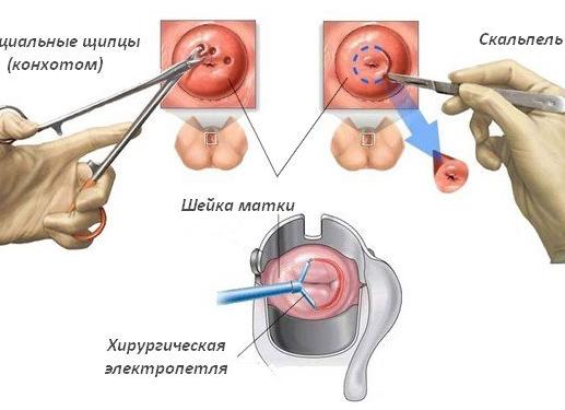 Биопсия матки что это такое