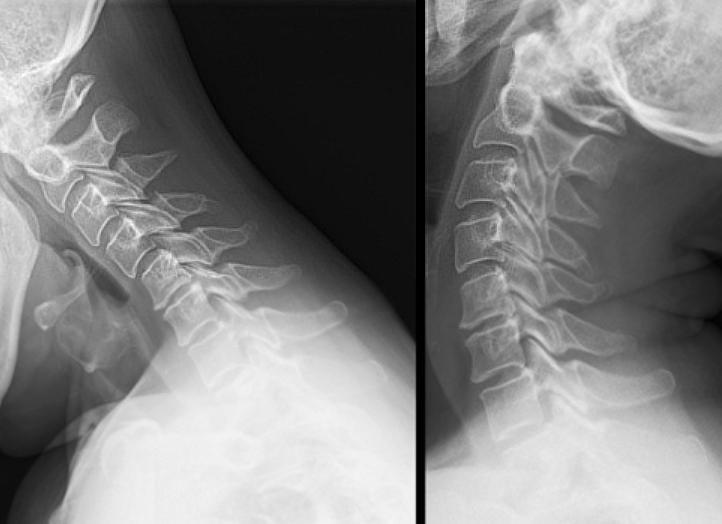Аномалия клиппеля фейля